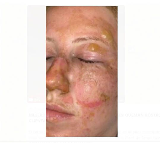 Mujer resulta quemada en festejo de cumpleaños