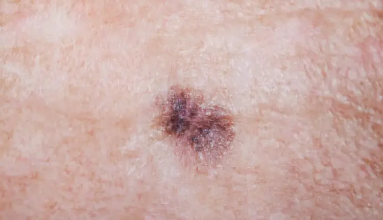 Cáncer de piel recibe nuevo avance con vacuna de ARNm contra el melanoma